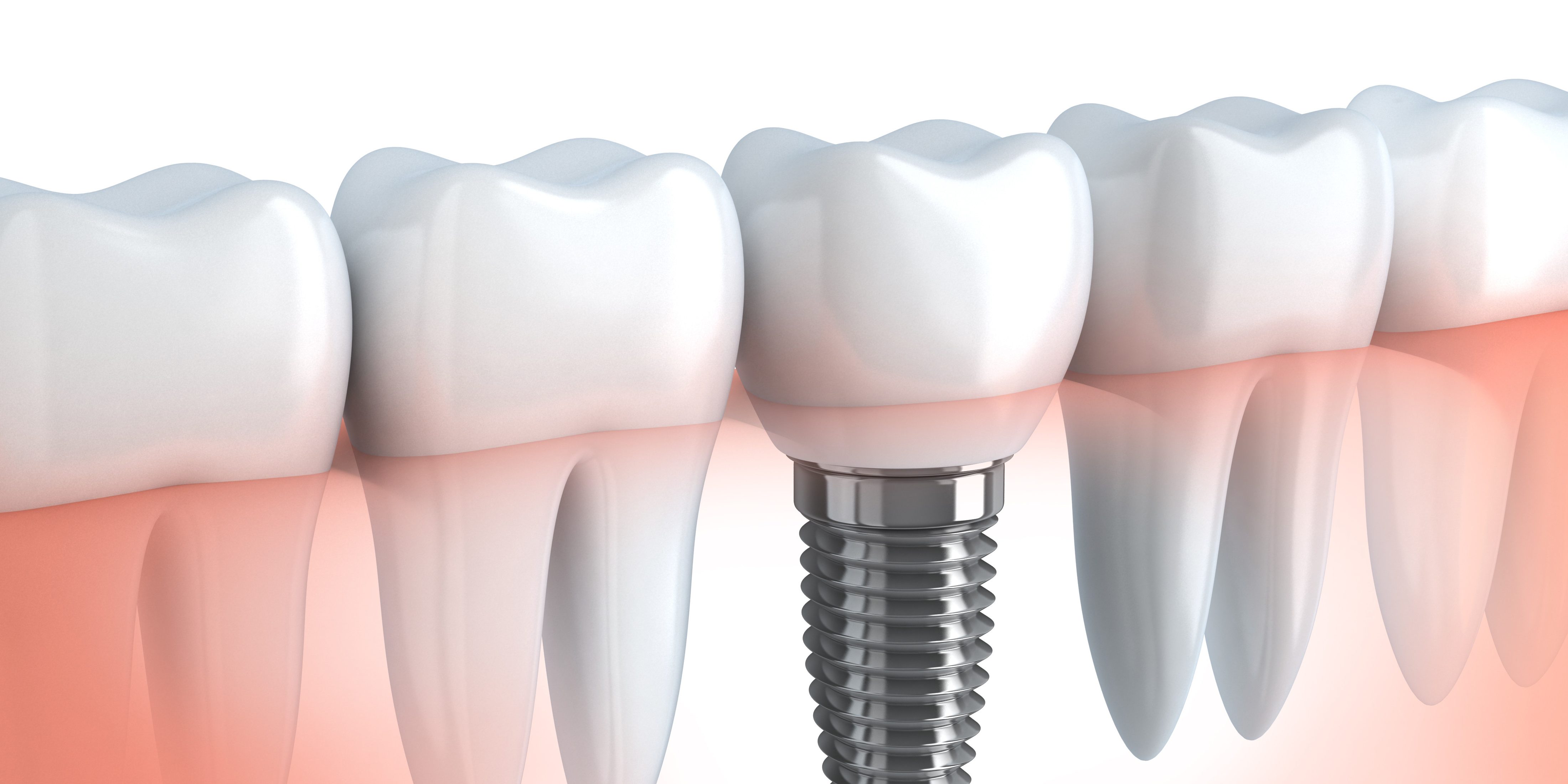 Зубной имплант спб. Osstem импланты. Имплантата dentis.